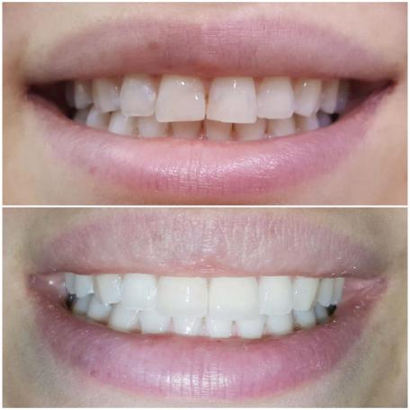 Emax Kronen, Bleaching