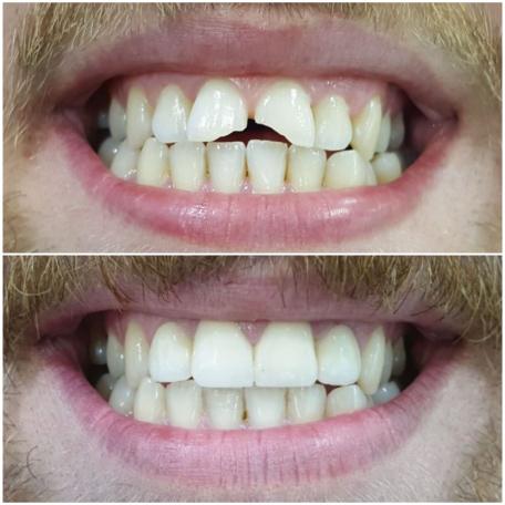 yessmile,Zirkonium Kronen